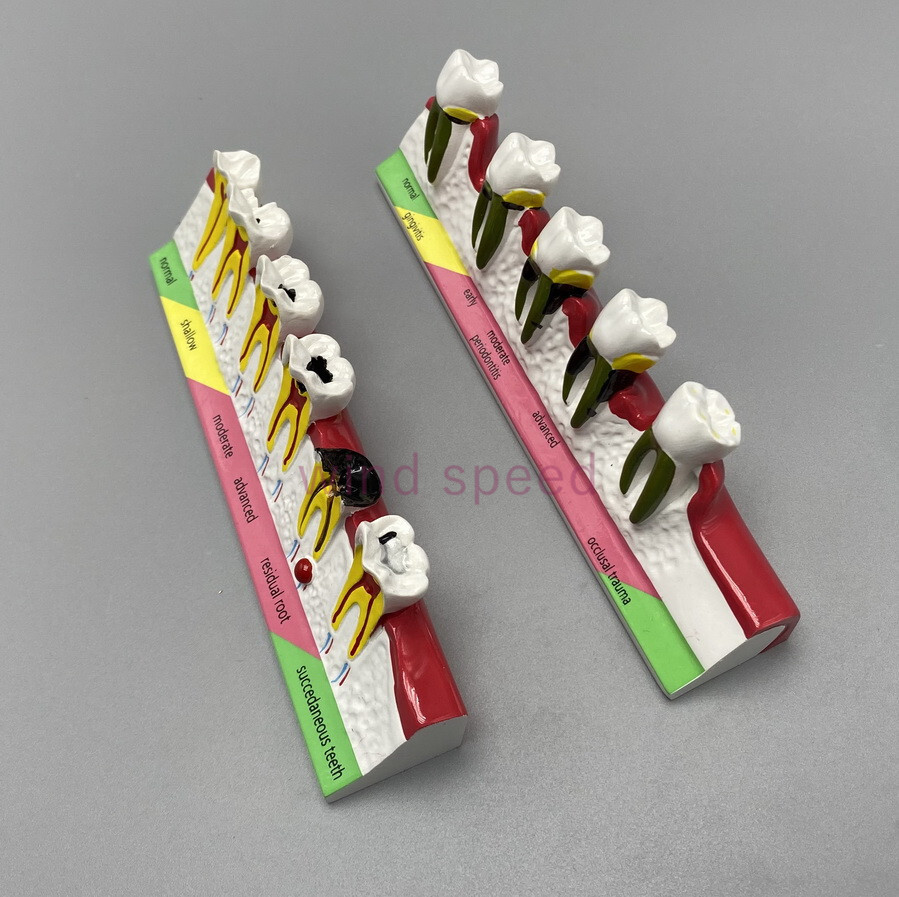 Dental Teeth Dentoform Typodont Caries Periodontal Disease Study Teaching Model