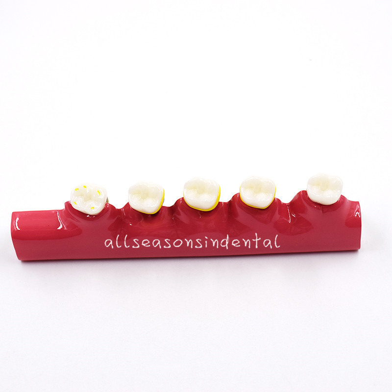 Dental Study Teaching Model Periodontal Disease Assort Teeth Dentoform Typodont