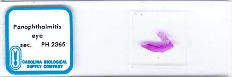 Human Panophthalmitis of Eye Pathology Microscope Slide