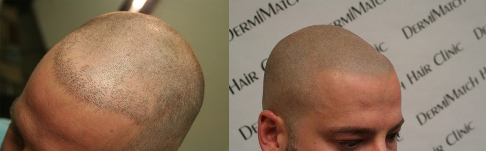 HD Scalp Micropigmentation Kit by DermiMatch