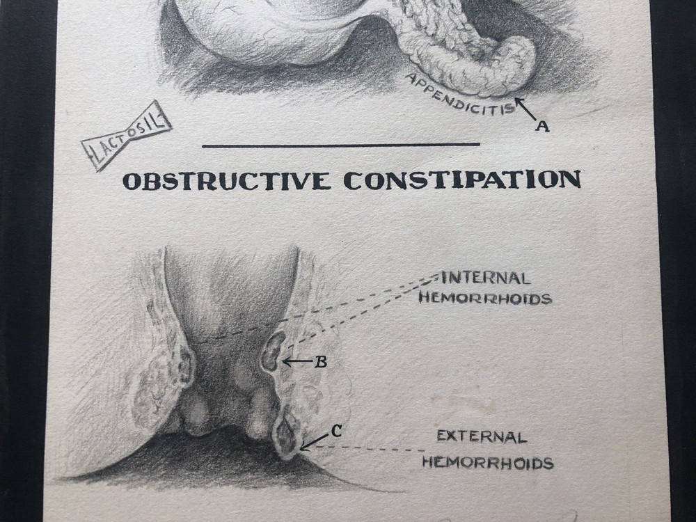 Vintage LACTOSIL Pencil Drawing Signed CONSTIPATION Appendicitis Hemorrhoids