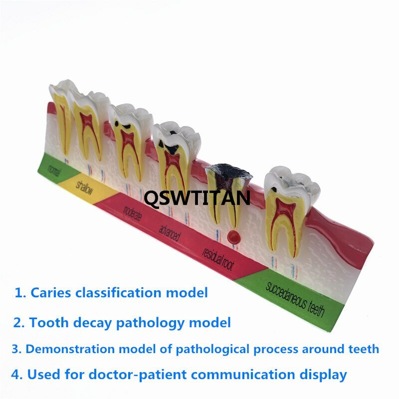 Dental Caries Classify/Evolution model Tooth Model Dental Study Model