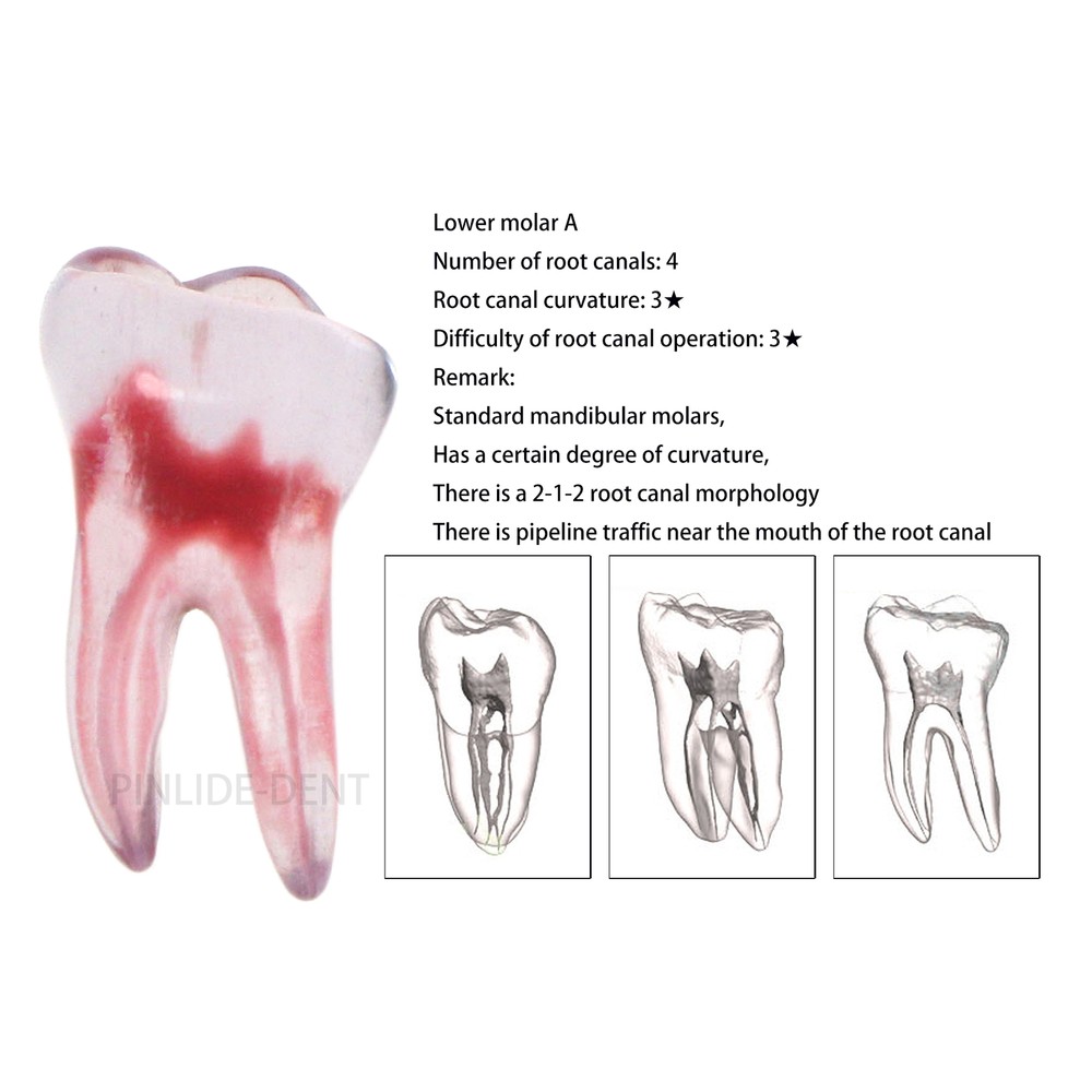 Dental Resin Root Canal Teeth Model Endo Practice Block RCT Pulp Cavity Study