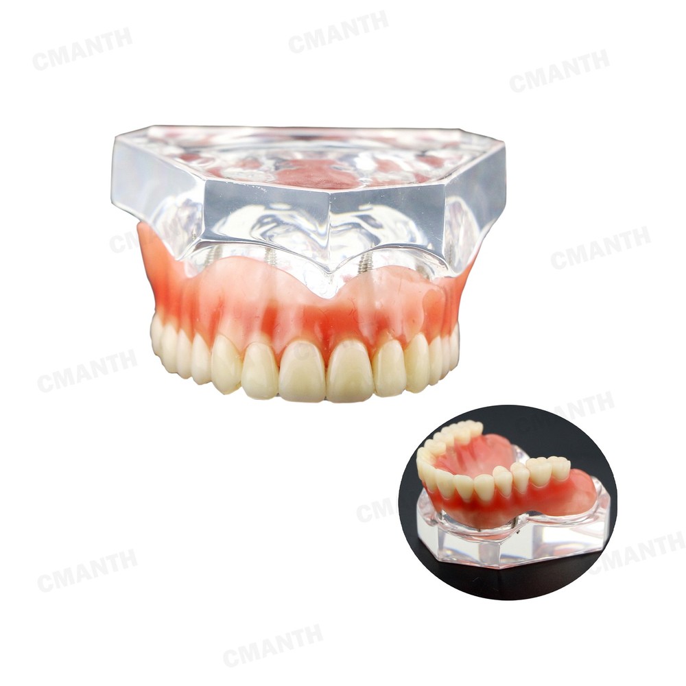 US Dental Model Removable Overdenture Teeth Upper/Lower Jaw 4 Implants Model