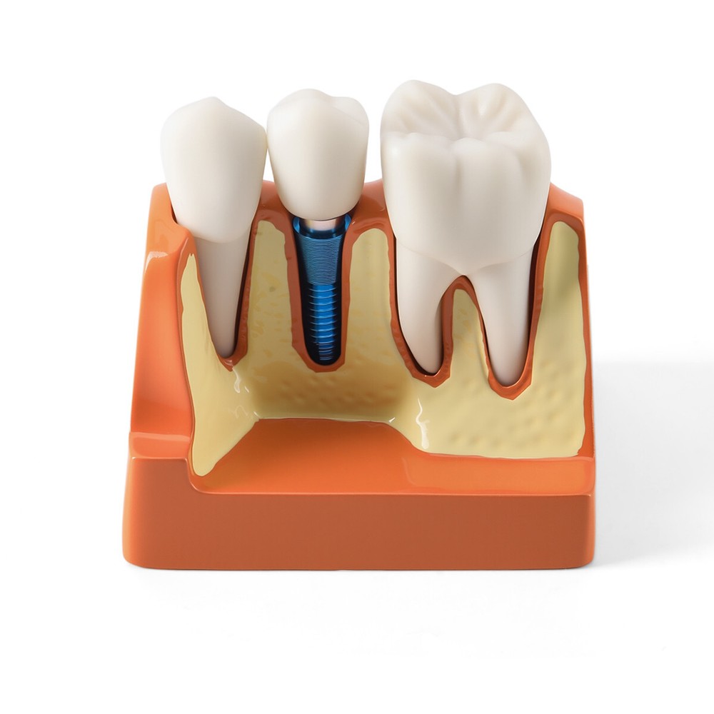 Dental 4Times Teeth Model Implant Analysis Crown Bridge Removable Study Training