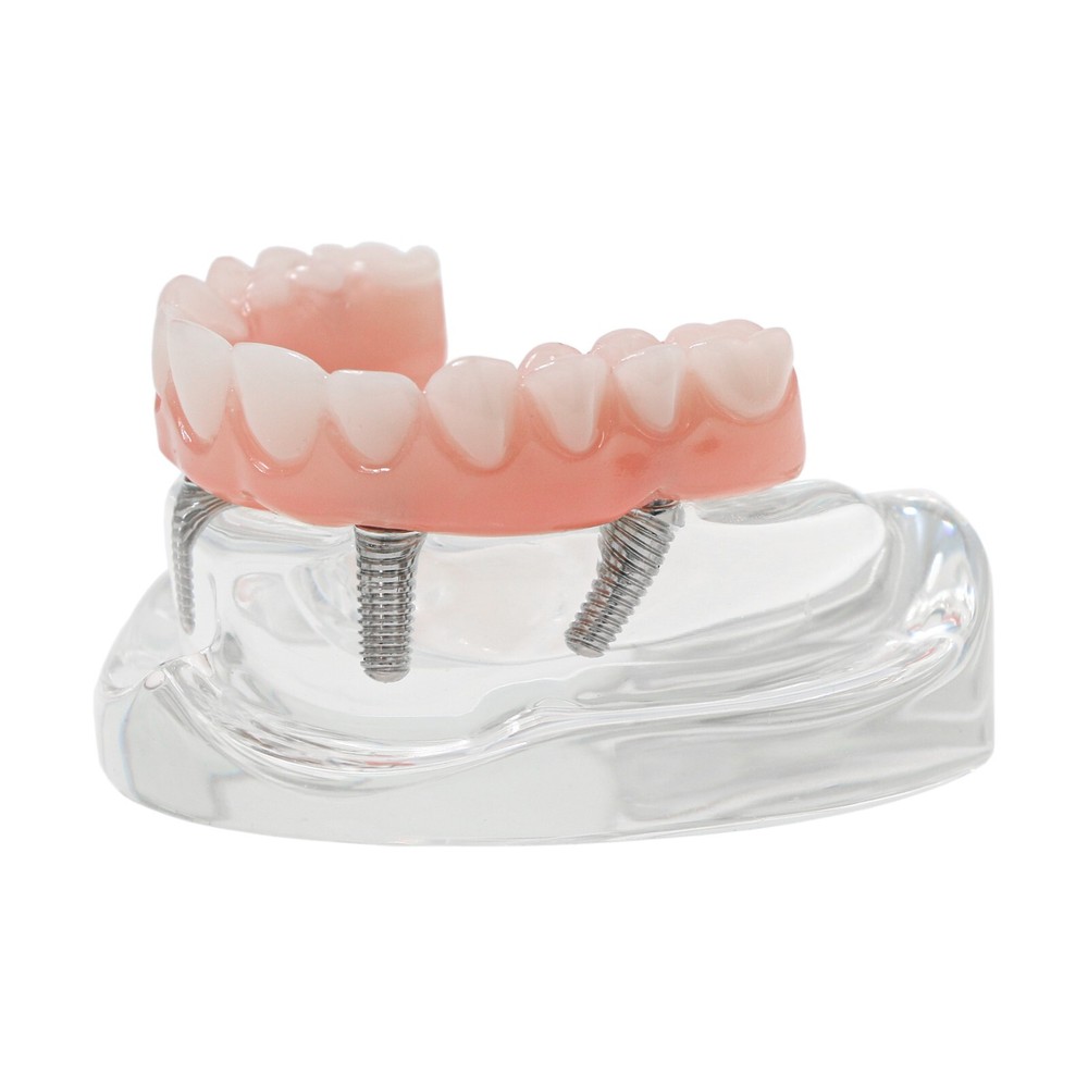 Implant Practice Demo Multiple Types Dental Teaching Teeth Model Typodont Ortho