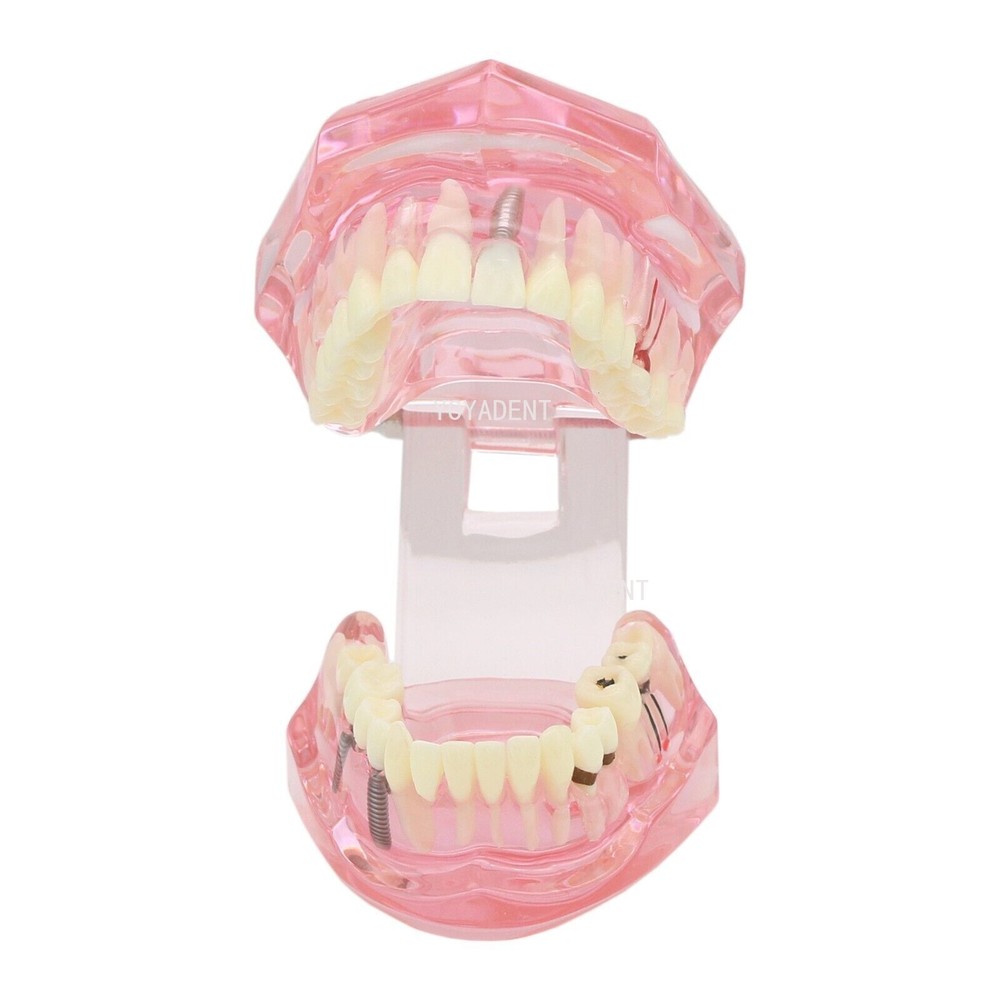 Multiple Types Dental Teaching Teeth Model Typodont Ortho Implant Practice Demo