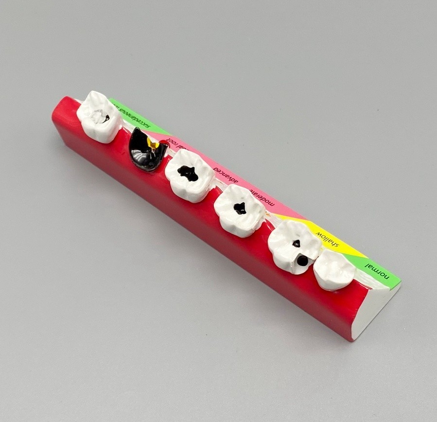 Dental Caries Disease Models Dentoform Typodont Study Teaching Teeth Model Demo