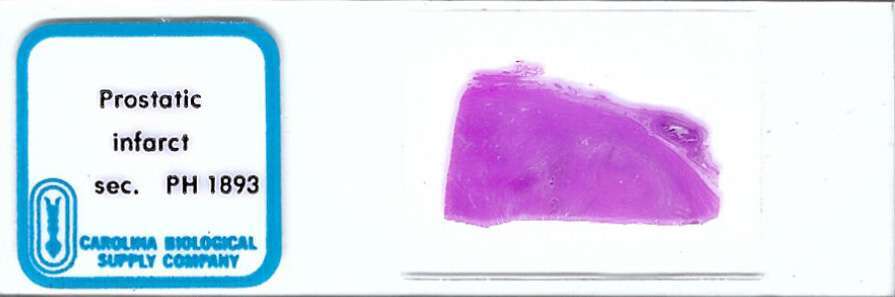 Human Prostatic Infarct Pathology Microscope Slide
