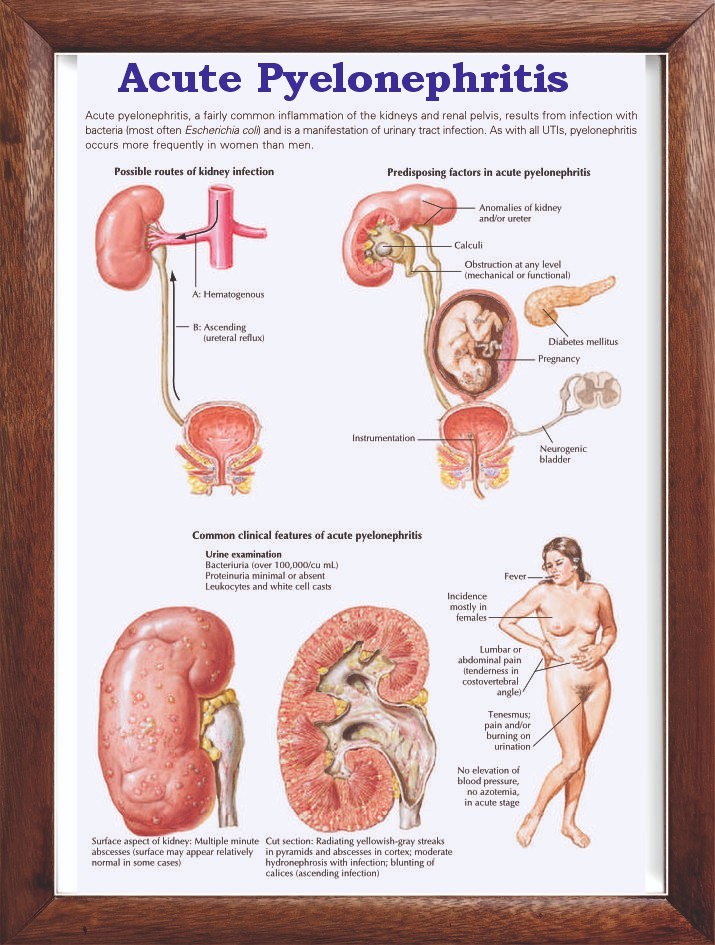 Acute Pyelonephritis Chart 12x18 inches
