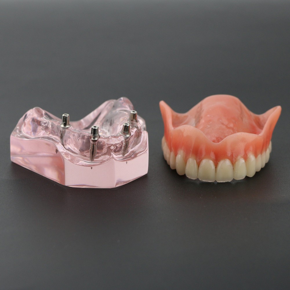 Dental Teeth Model Demo Overdenture Restoration With 4 Implants Upper Maxillary
