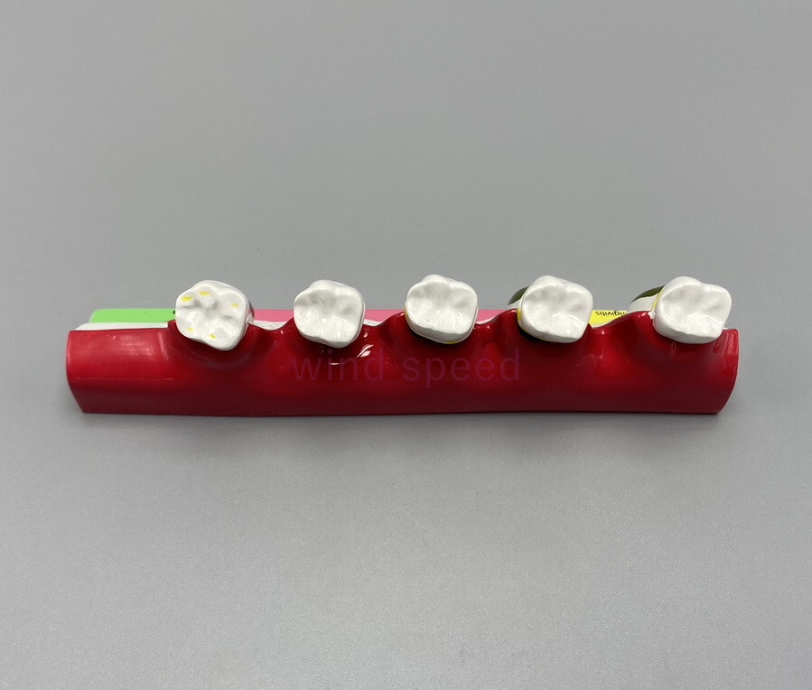 Dental Teeth Dentoform Typodont Caries Periodontal Disease Study Teaching Model