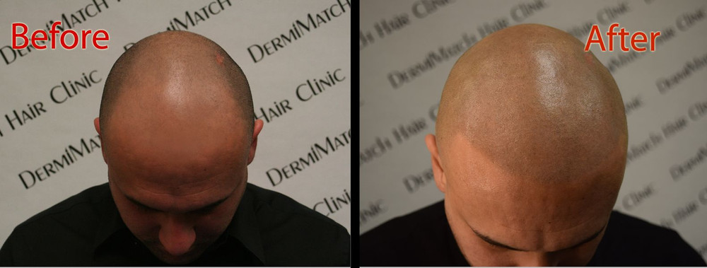 HD Scalp Micropigmentation Kit by DermiMatch