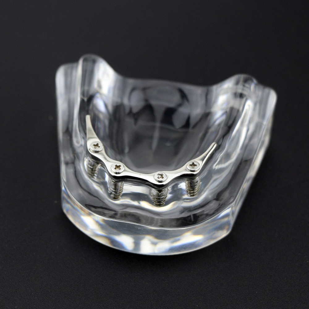 Dental Teeth Model Inferior Overdenture Precision 4 Implants Demo Silver Bar