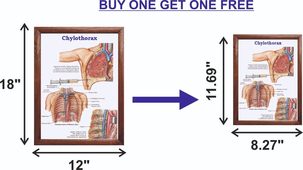 Chylothorax Chart 12x18 inches