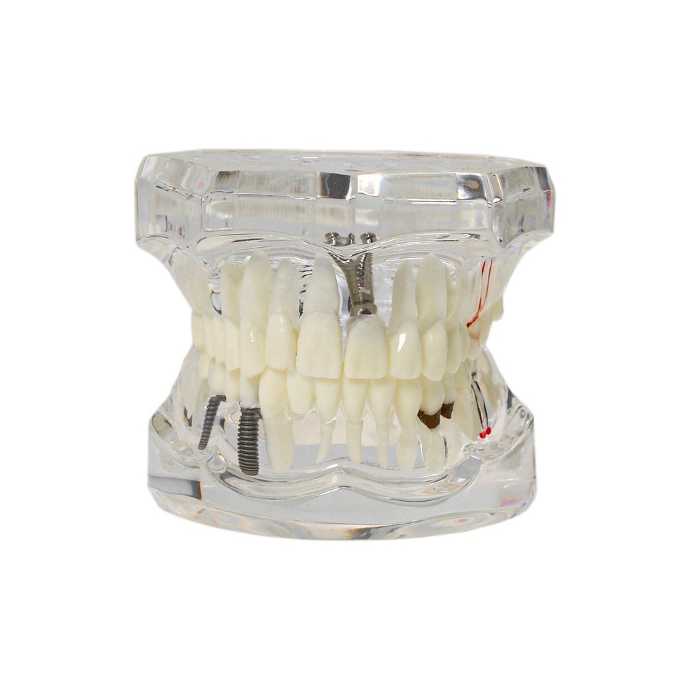 Implant Teeth Model Dental Typodont Ortho Pathological Perio Practice Demo Model