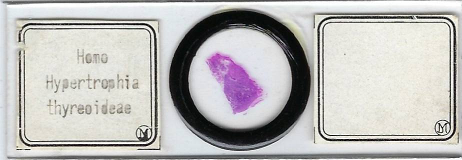 Human Thyroid Hypertrophy Pathology Microscope Slide by Moeller