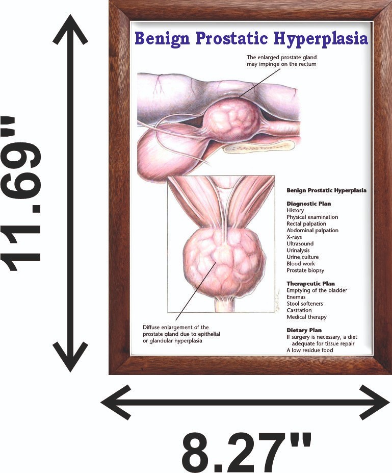 Benign Prostatic Hyperplasia Chart 12x18 inches