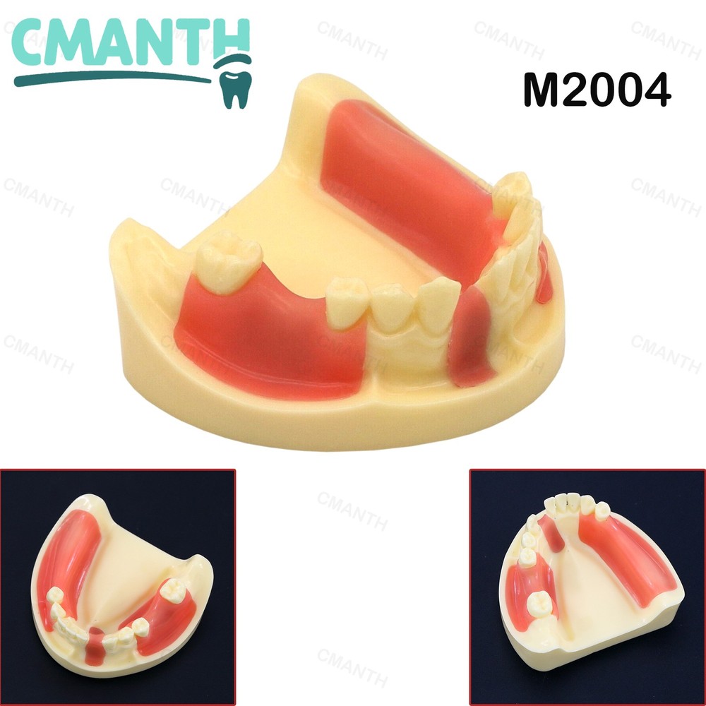 Dental Teeth Model Gingiva Removable Implant Drilling Practice Teeth Model M2004