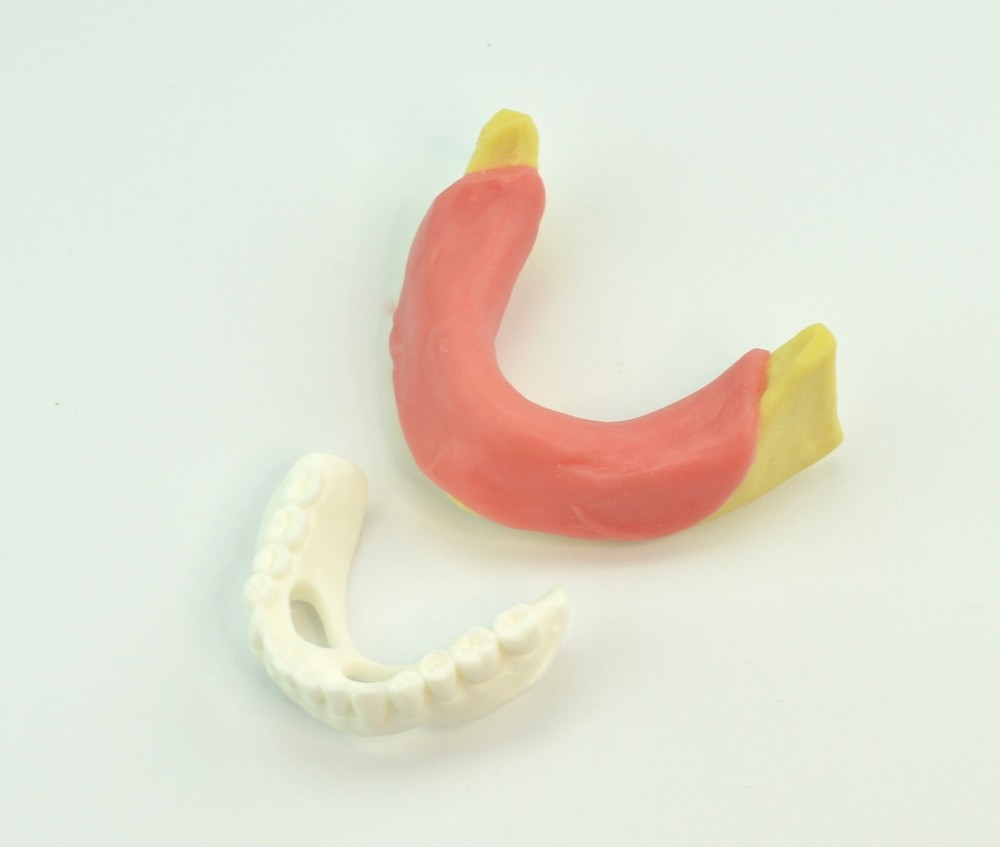 Dental Mandibular Implant Plus Denture Training Model Implant Placement