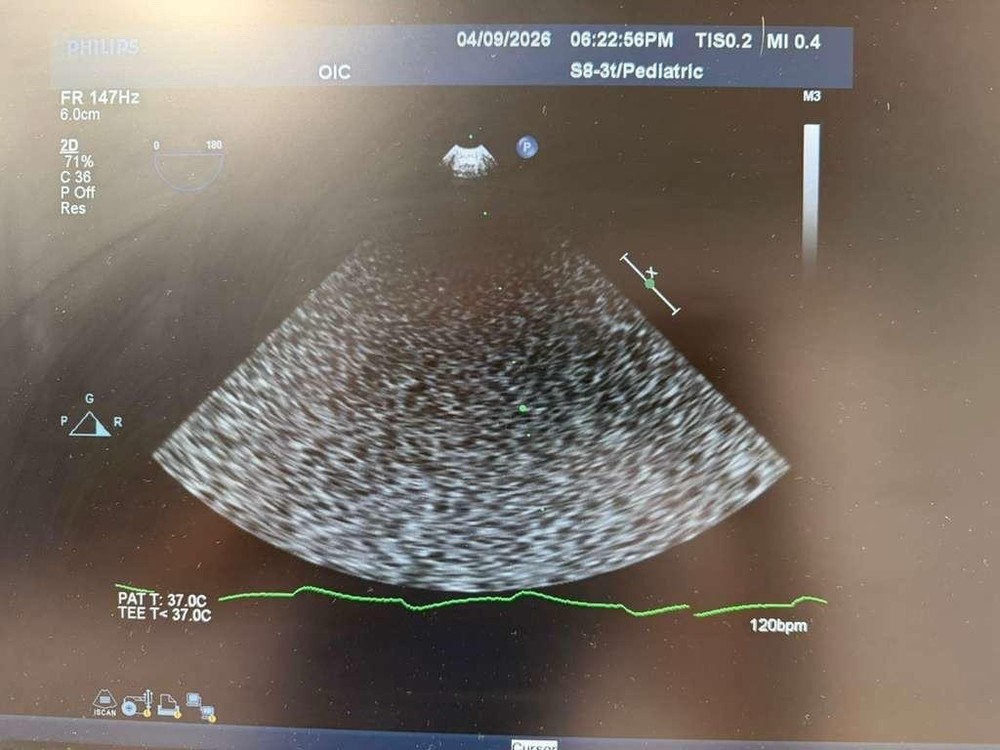 Philips S8-3t Multiplane microTEE Transducer Ultrasound Probe