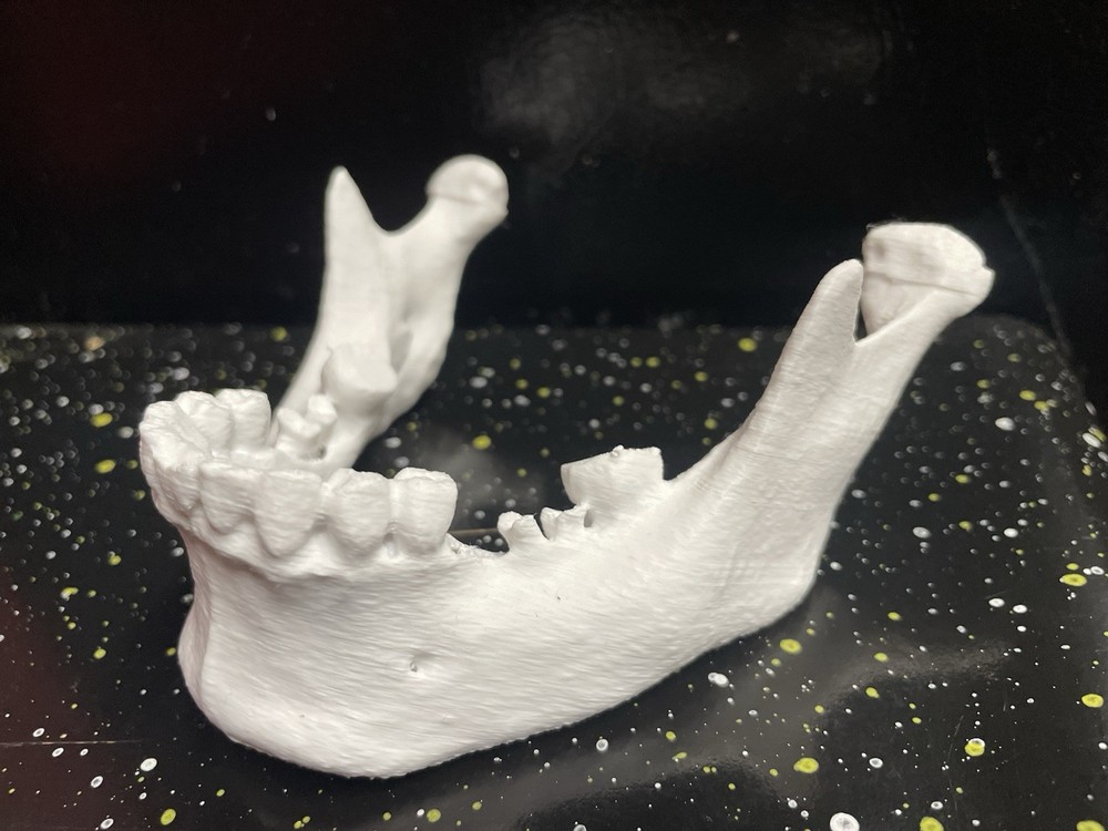 3D PRINTED HUMAN 3d JAW BONE