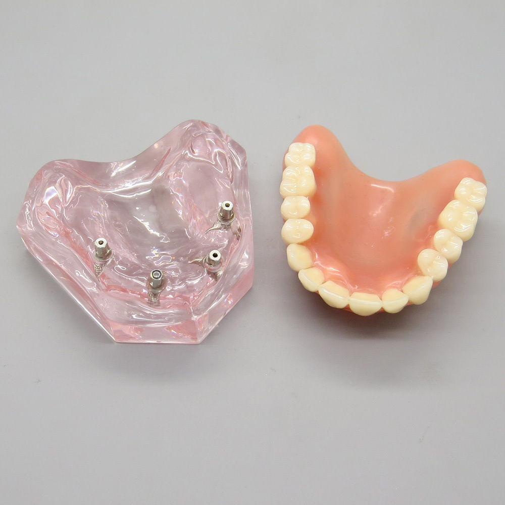 Dental Implant Teeth Model Demo Overdenture Restoration Teaching Study 4 Models