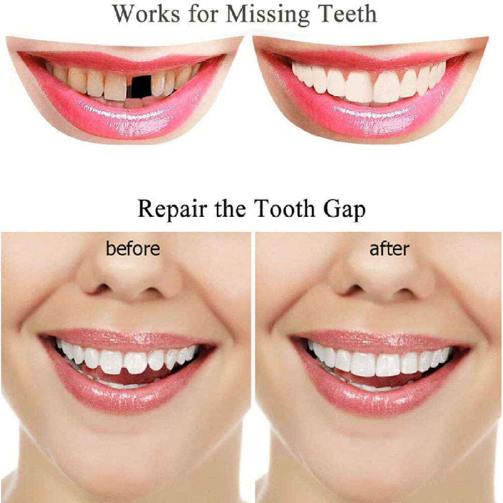 3X Tooth Repair Kit - Temporary Teeth Replacement Kit for Missing & Broken Teeth