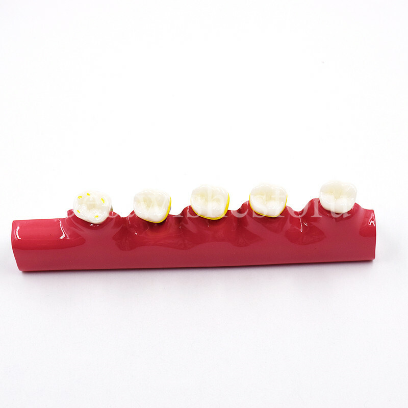 Dental Periodontal Disease Assort Developing Demonstration Teeth Study Model