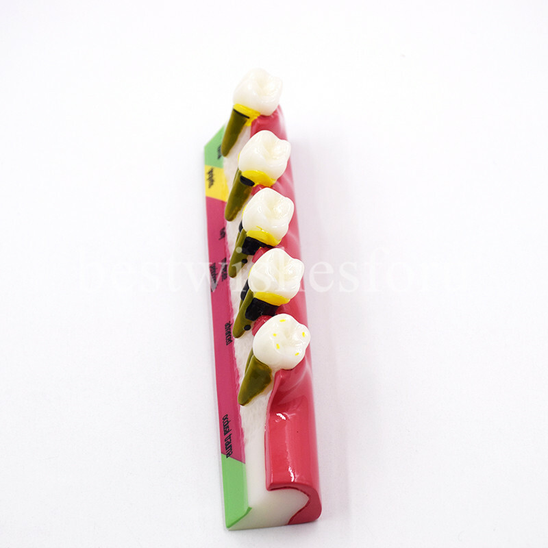 Dental Periodontal Disease Assort Developing Demonstration Teeth Study Model