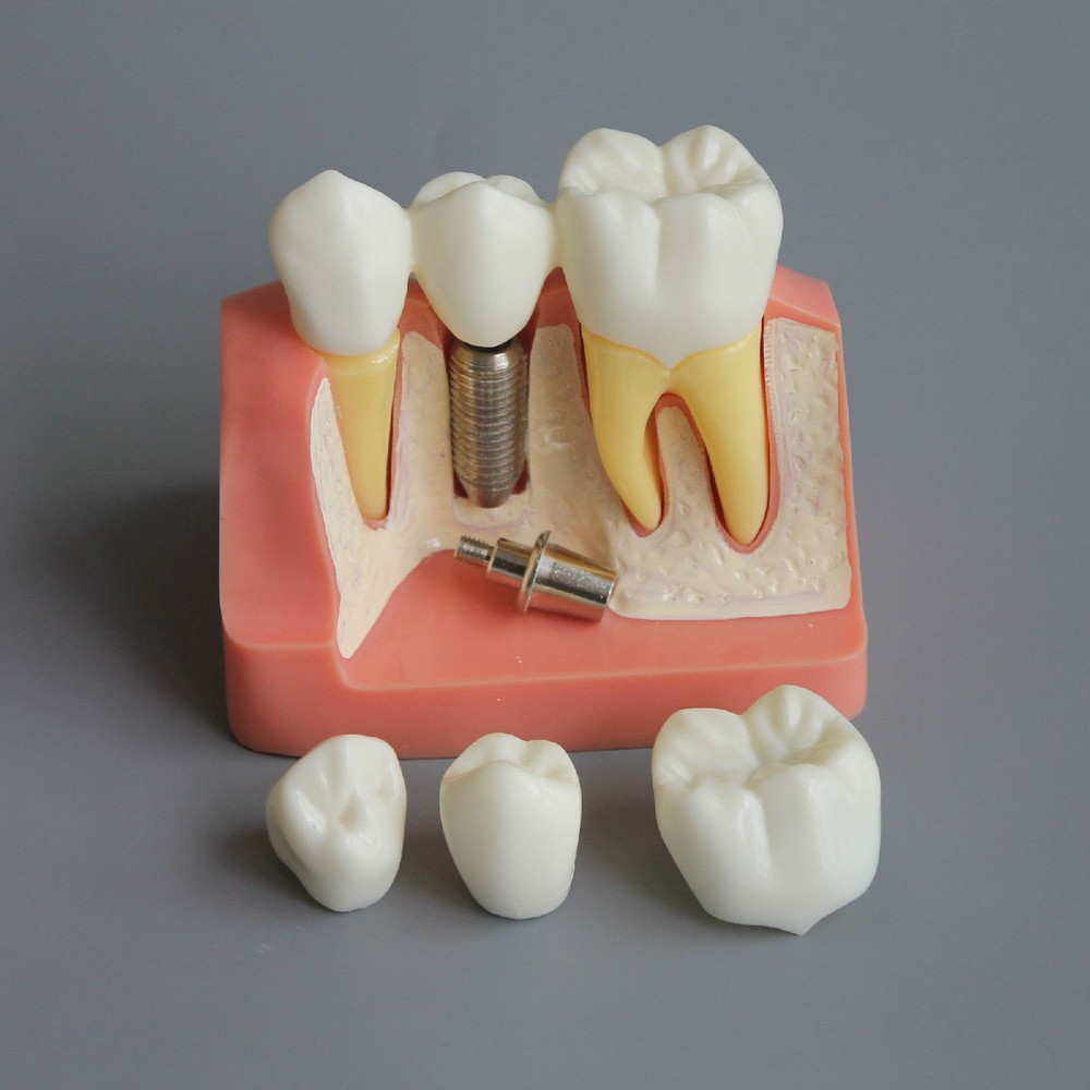 Dental Demonstration Removable Teeth Model Implant Analysis Crown Bridge Study