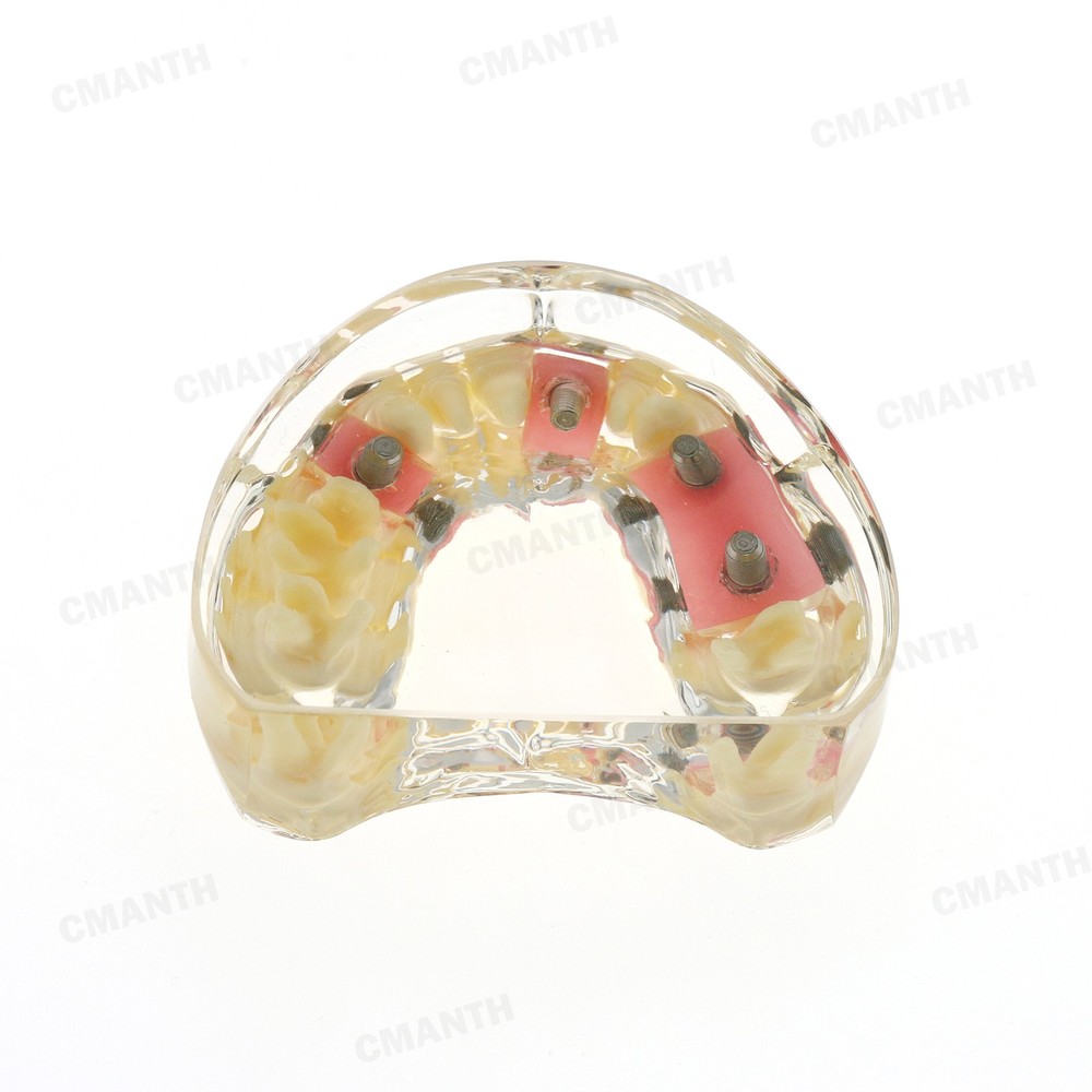 Dental Teeth Pathological Perio Practice Implant Model Studying Teaching M2005