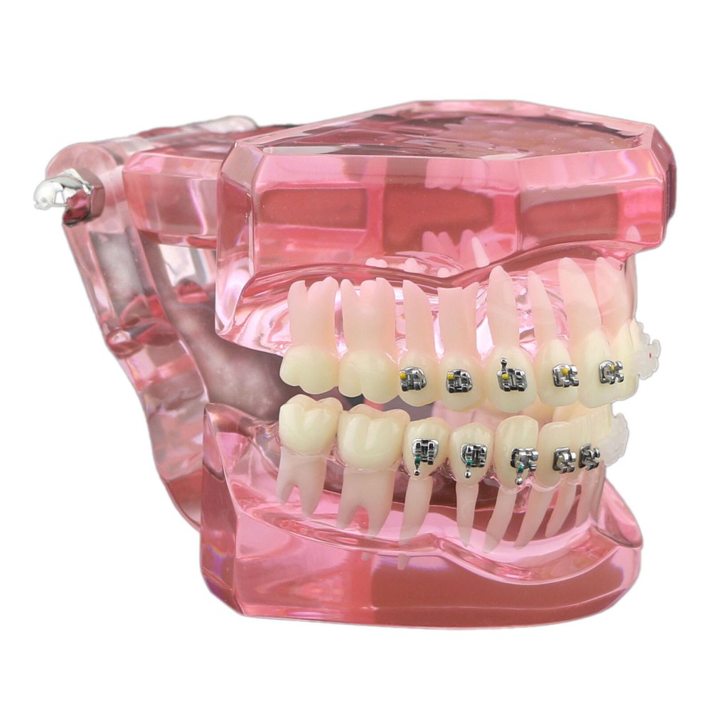 Dental Orthodontic Demonstration Ceramic and Metal Bracket Study Typodont Model