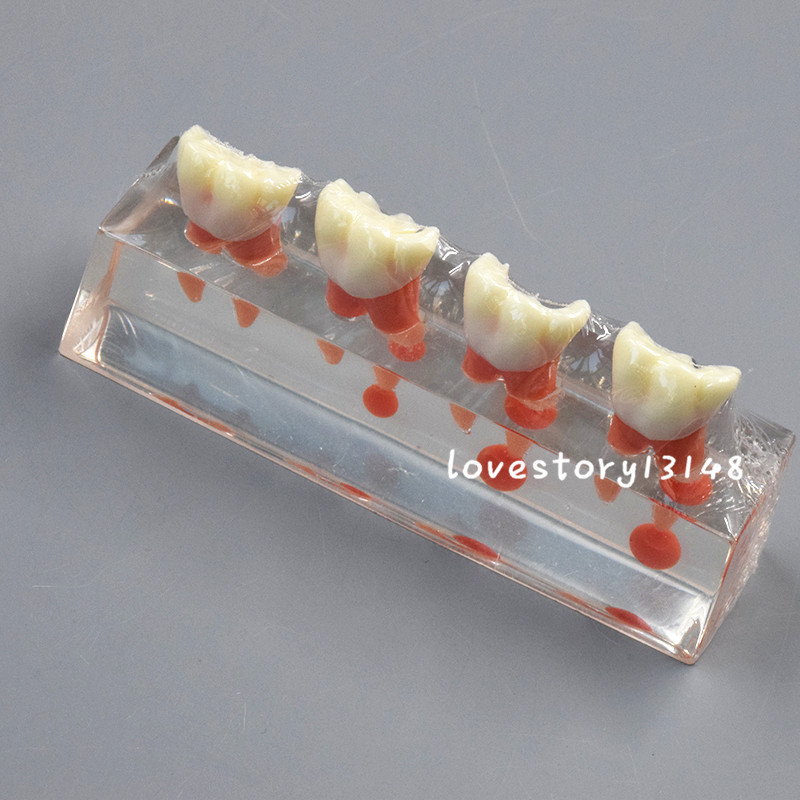 1 Set Dental Teeth Model #4018 01 - 4-Stage Endodontic Treatment Study Model