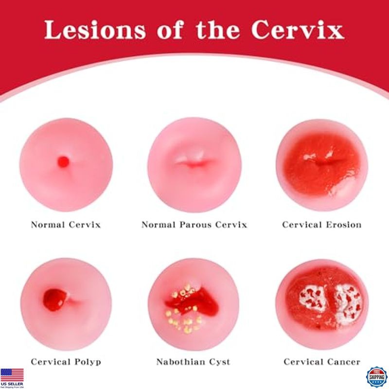 SimCoach Cervical Pathology Model Set - 6 Realistic Cervix Replicas for Training