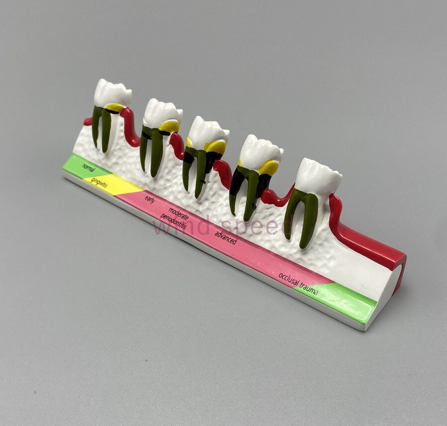 Dental Teeth Dentoform Typodont Caries Periodontal Disease Study Teaching Model