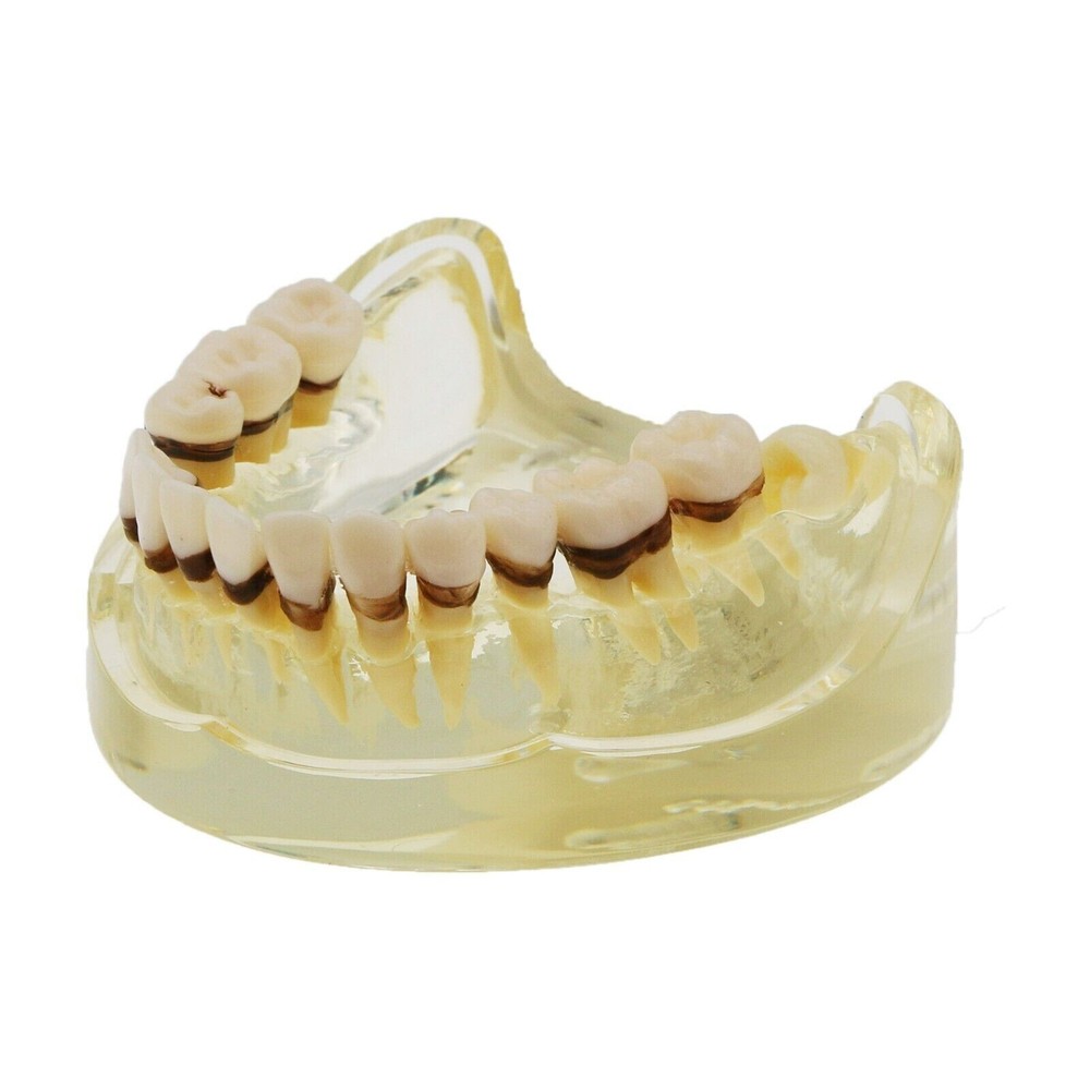 Dental Periodontal Pathological Disease M4017 Removable Teaching Study Model