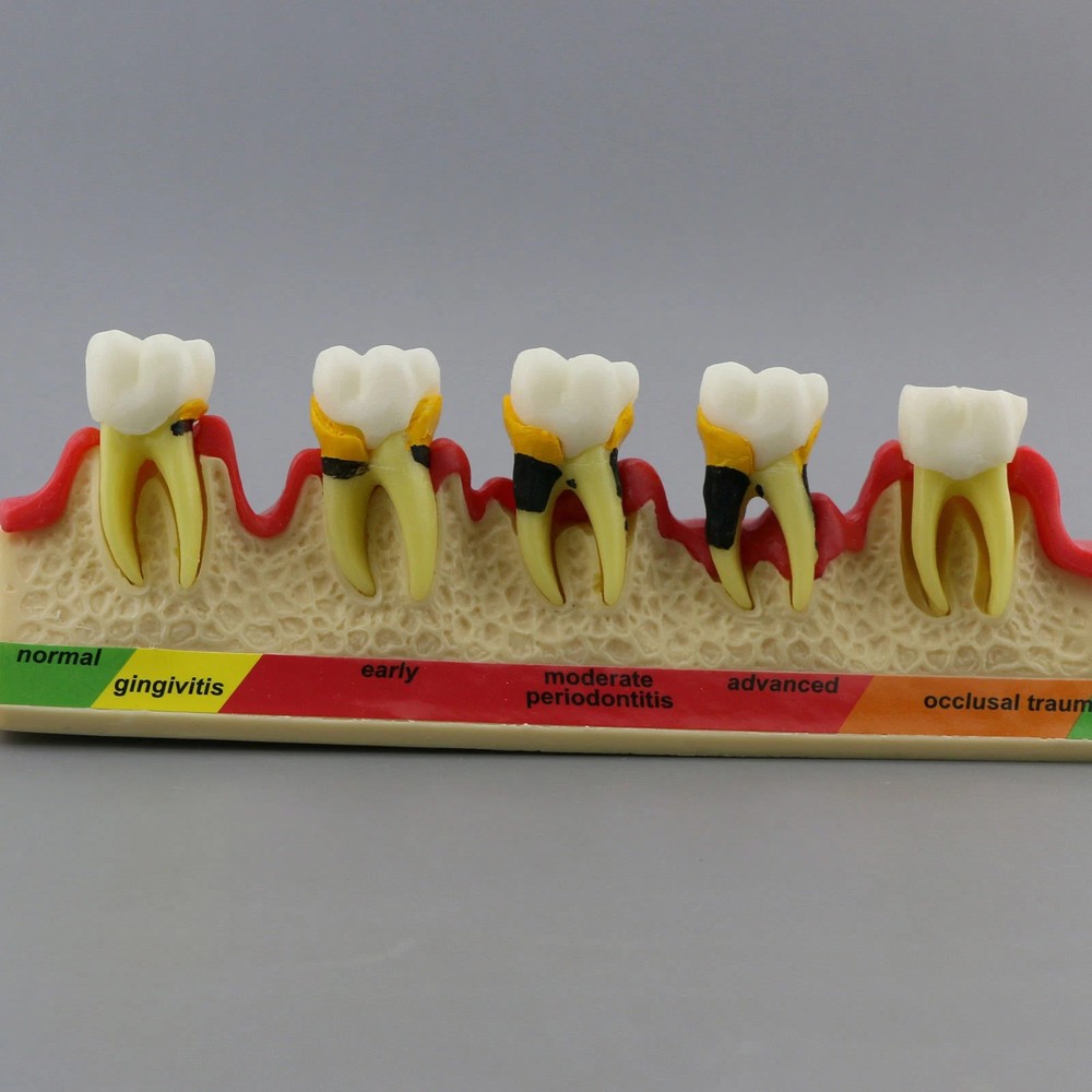 Dental Dentoform Periodontal Disease Assort Teeth Teaching Study Model Typodont