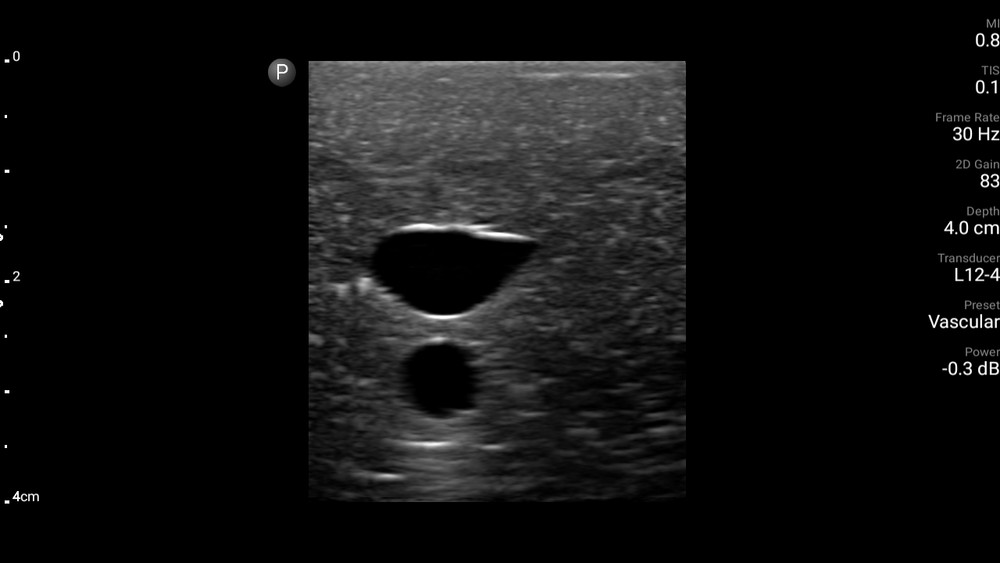 Internal Juglar ultrasound phantom -CVC (FLUID FREE)
