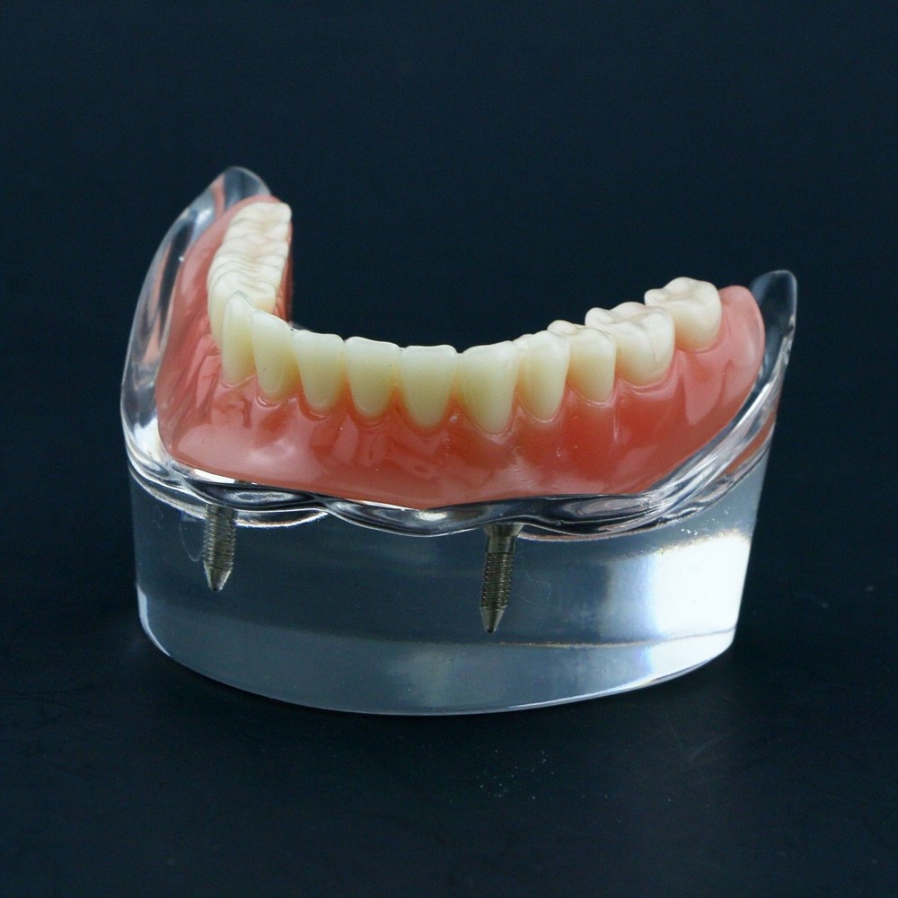 Dental Oral Transparent Upper Teeth 2/4 Implants Model Overdenture Restoration
