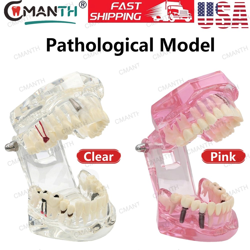 US Dental Implant Restoration Model Transparent Pathological Teeth Study Demo