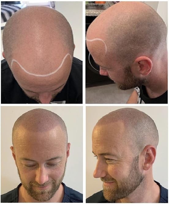 Nuva Scalp Micro-Pigmentation Ink - Customizable, Neutral Undertone for SMP P...