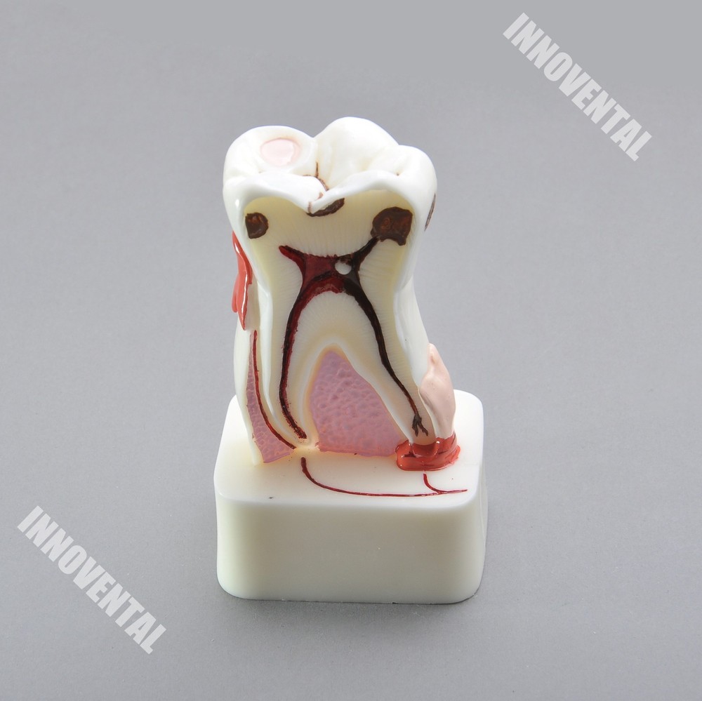 Dental Model #4015 01 - Pathological Molar Study Model