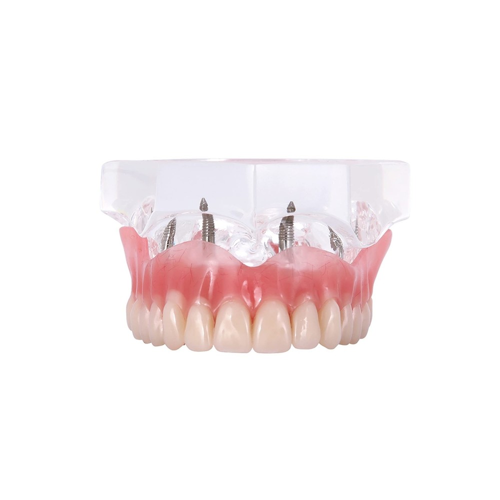 Dental Upper Implants Model Overdenture with 4 Superior Teeth Demo Transparen...