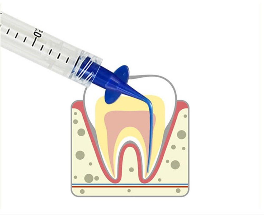 Dental Vitapex Premixed Calcium Hydroxide Paste Root canal filling With Tips PD