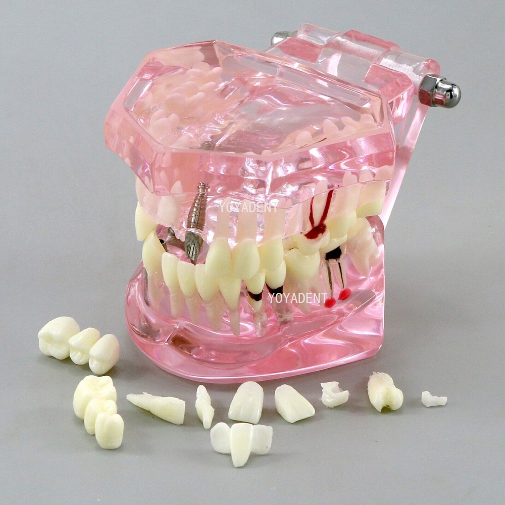 Multiple Types Dental Teaching Teeth Model Typodont Ortho Implant Practice Demo