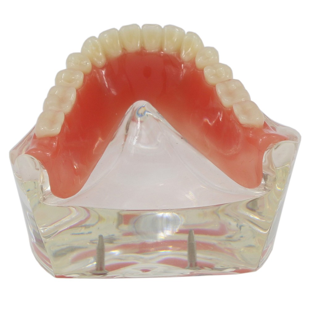 Implant Restoration Teeth Model Mandibular Overdenture with 2 Implants Dental