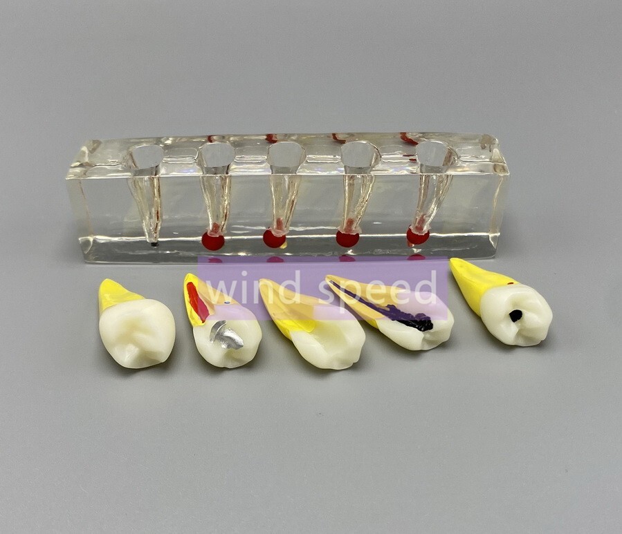 Dental Study Model Pulp Disease root canal curing Clinical Demonstration Analysi