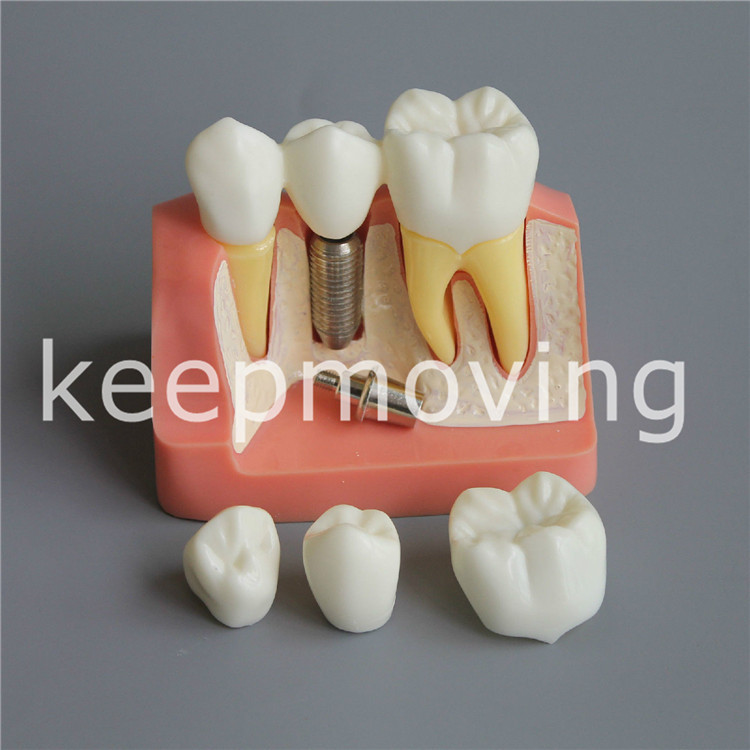 Dental Implant Analysis Crown Bridge Demonstration Teeth Tooth Model Typodont
