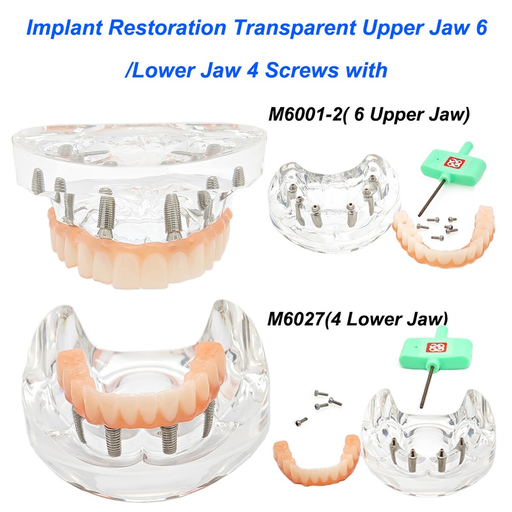 Dental Implant Teeth Model Transparent Upper/ Lower Jaw 6/4 Overdenture Modle